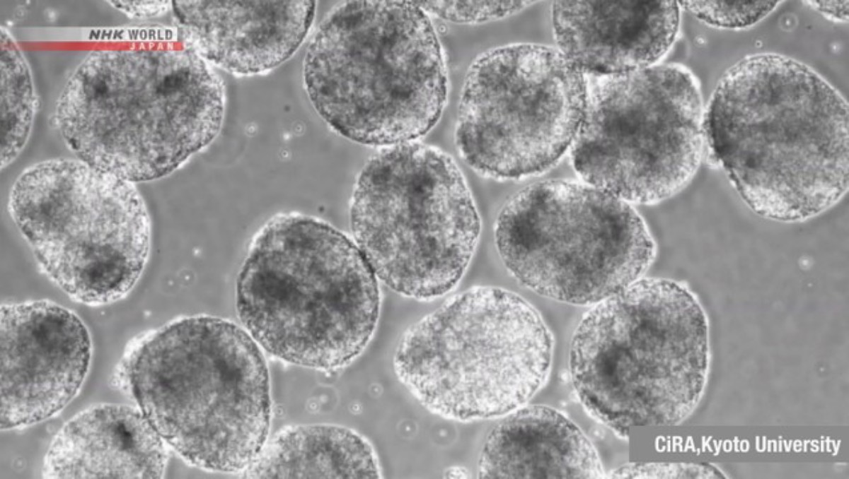 Terobosan Medis: Jepang Setujui Penggunaan Praktis Produk Sel iPS Pertama di Dunia